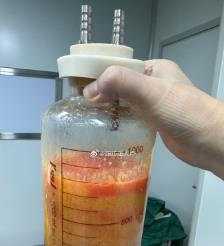 溧阳水动力吸脂手术要做多久？